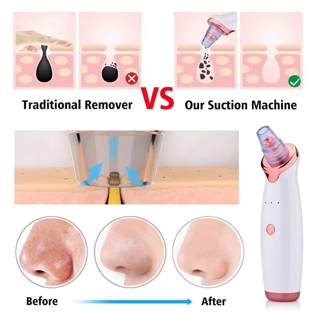 Blackhead Electric Suction Facial Cleaner, Beauty Instrument for Acne Removal and Blackhead Cleaning.